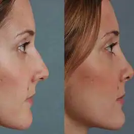 چگونه از تغییر نوک بینی بعد از عمل و افتادگی آن جلوگیری کنیم؟