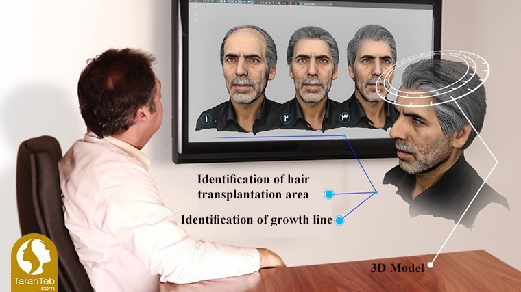 Hair transplantation by 3D scan method