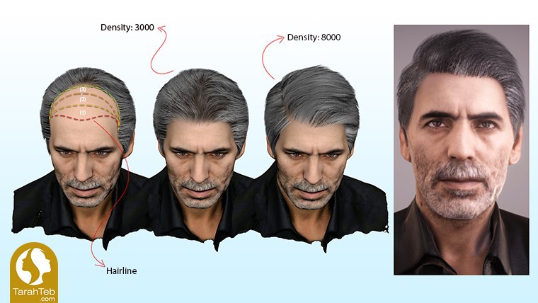 Hair transplantation by 3D scan method