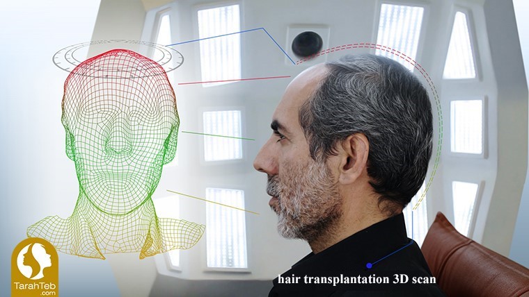 Hair transplantation by 3D scan method