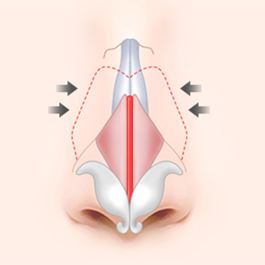 Wide nose rhinoplasty 