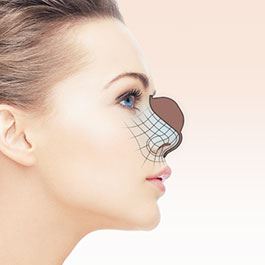 Rhinoplasty 