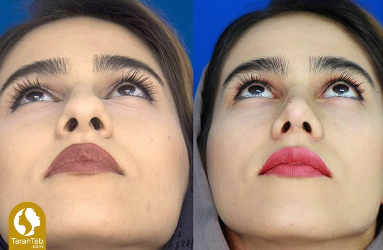 اصلاح سوراخ‌های بینی