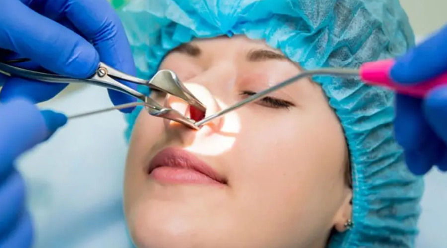 اصلاح شاخک ‌های بینی با جراحی 