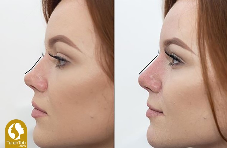 اصلاح فرورفتگی‌ها با تزریق فیلر بینی