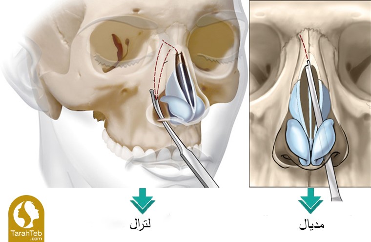 انواع استئوتومی در عمل بینی