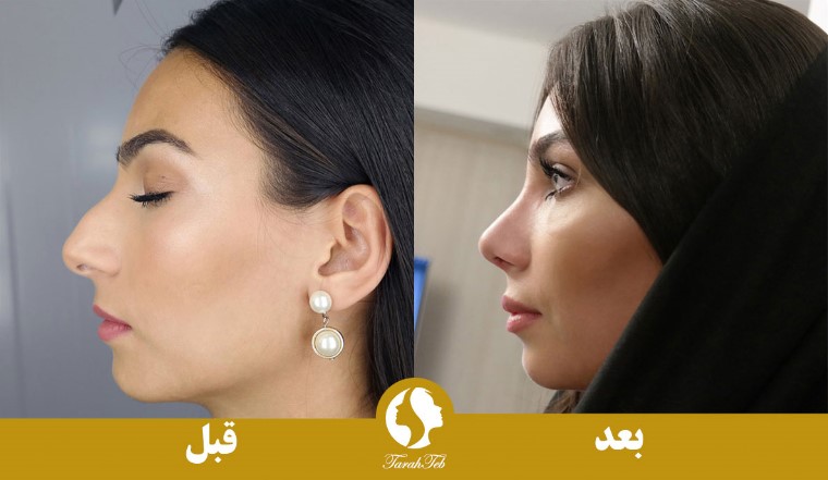 تصویر قبل و بعد از جراحی بینی با قالب کنترلی 1