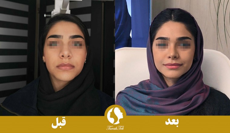 تصویر قبل و بعد از جراحی بینی با قالب کنترلی