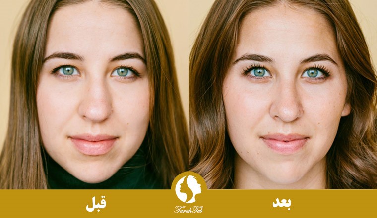 جراحی بینی طبیعی