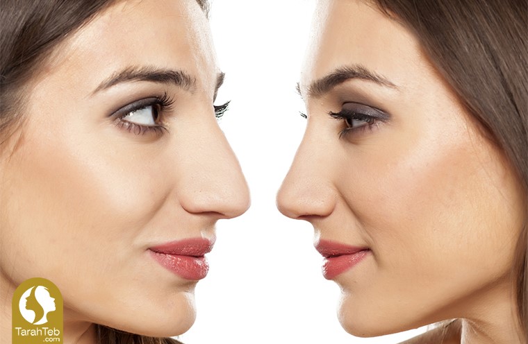 روش‌های کوچک کردن بینی