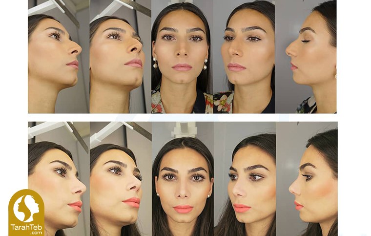 عکس‌های قبل و بعد از جراحی زیبایی بینی