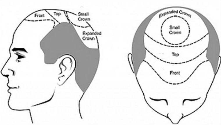 قسمت های مختلف سر در کاشت مو