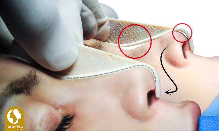 مرحله ششم جراحی بینی با قالب کنترلی