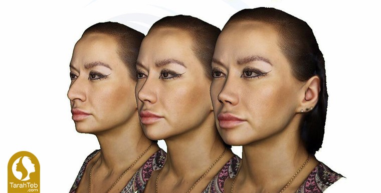 نتیجه‌ی جراحی زیبایی بینی مطابق میل