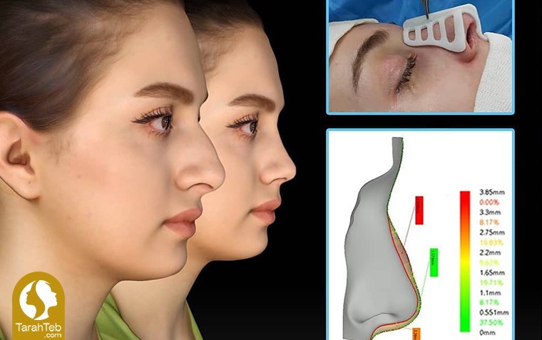 نتیجه‌ی عمل جراحی بینی