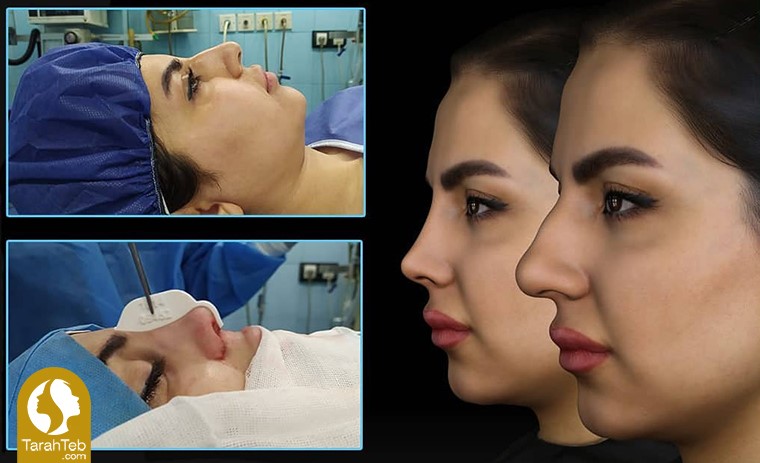 نتیجه‌ی عمل جراحی زیبایی بینی گوشتی