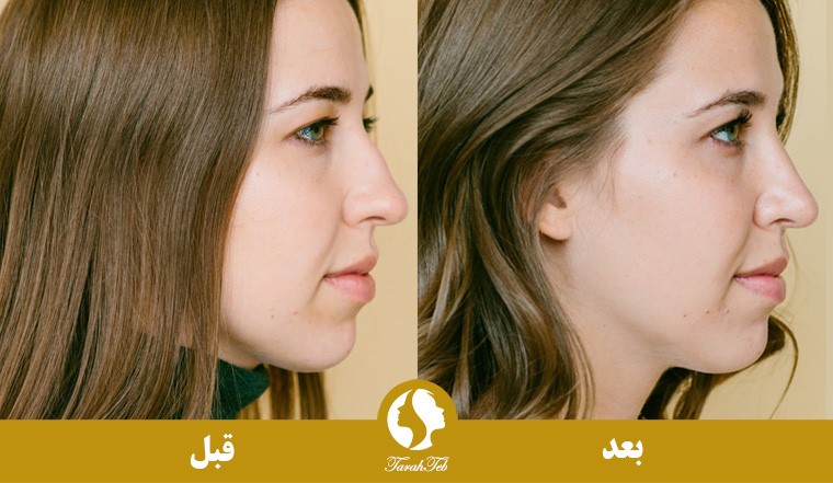 نمونه عکس عمل بینی