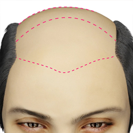 نمونه نمایش کاشت موی سه بعدی