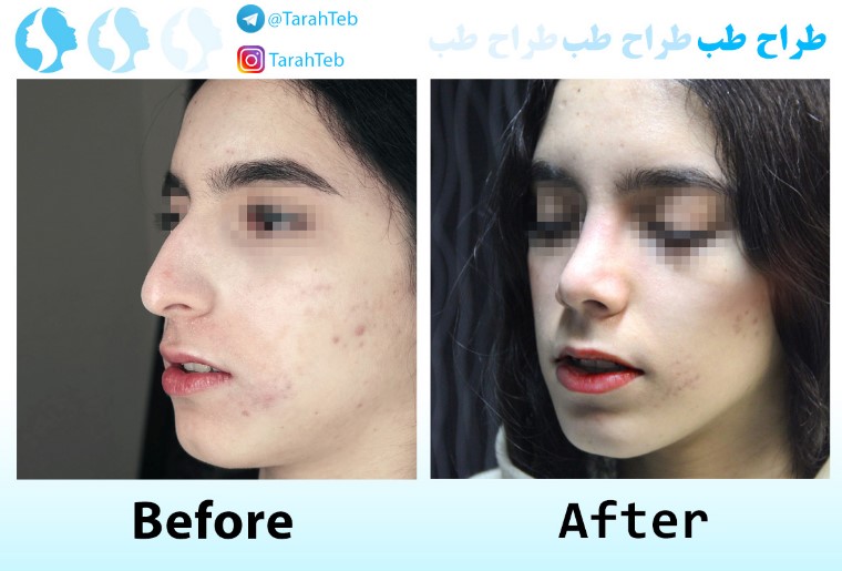 نمونه کار عمل بینی استخوانی