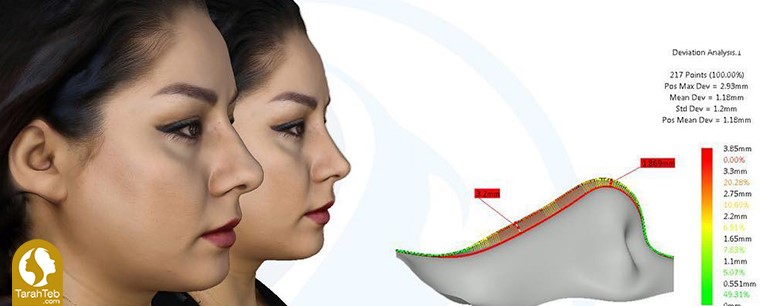 نگرانی از نتیجه‌ی عمل بینی