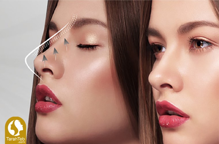 چگونه بینی خود را بدون جراحی تغییر دهیم؟