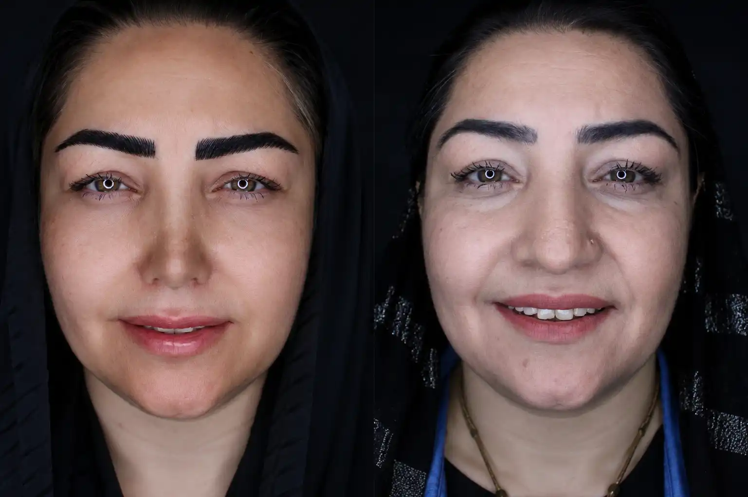 بینی گوشتی - تصویر 1