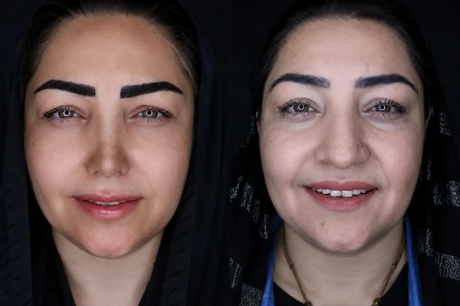 بینی گوشتی - تصویر 1