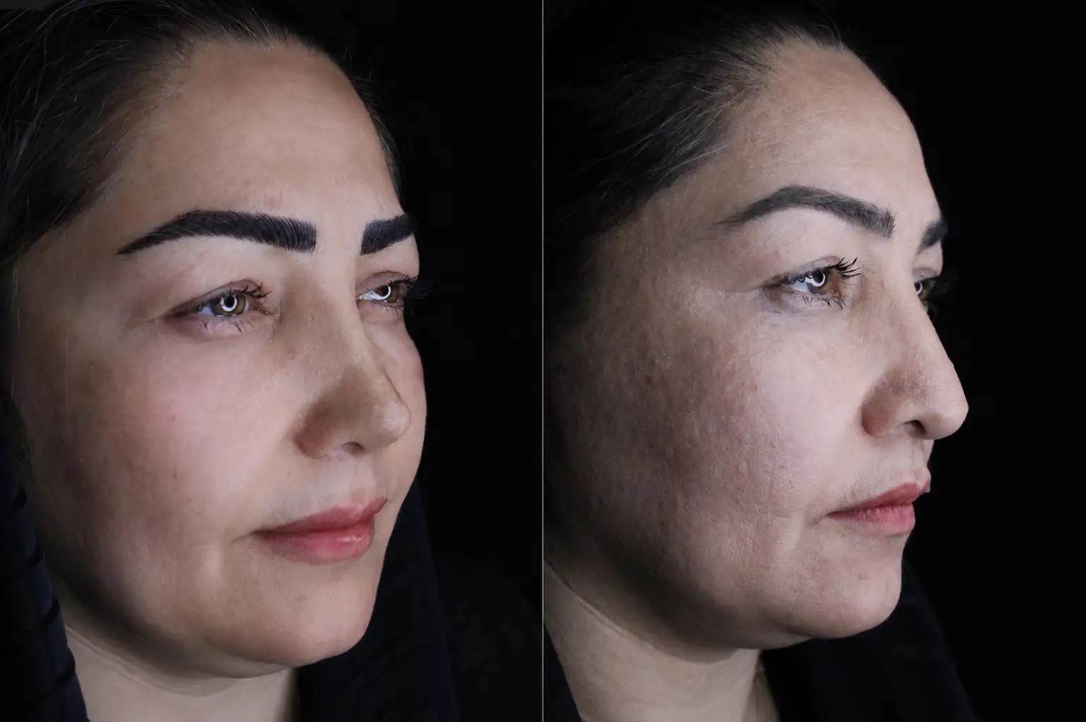 بینی گوشتی - تصویر 2