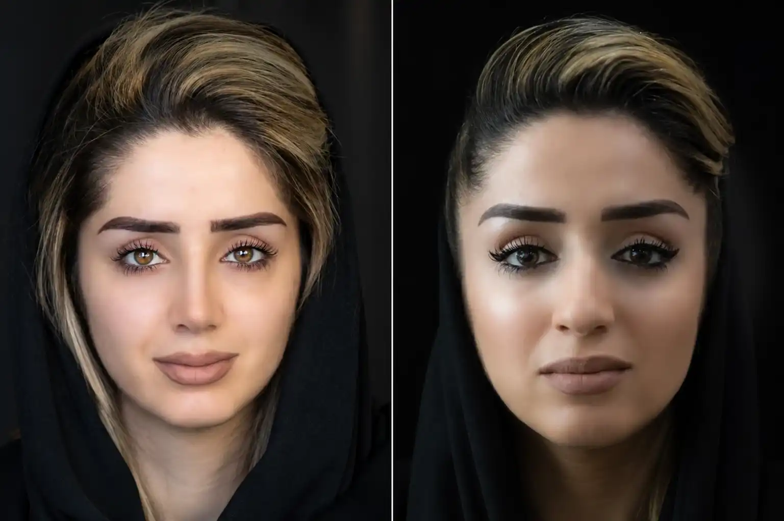 نمونه قبل و بعد عمل بینی شماره 28 - تصویر 1