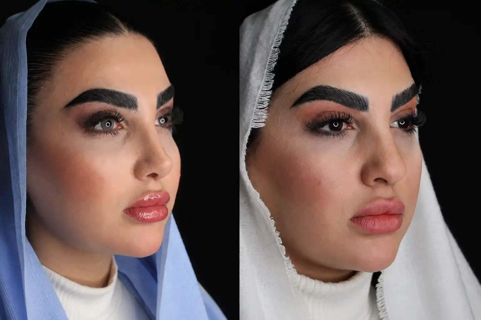 نمونه قبل و بعد عمل بینی شماره 30 - تصویر 1