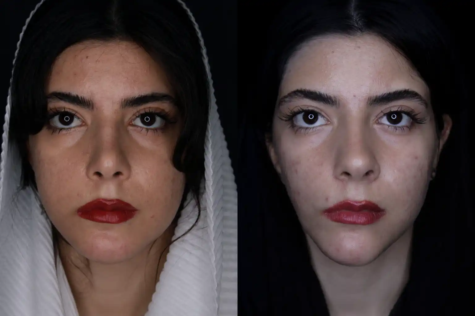 نمونه قبل و بعد عمل بینی شماره 34 - تصویر 1