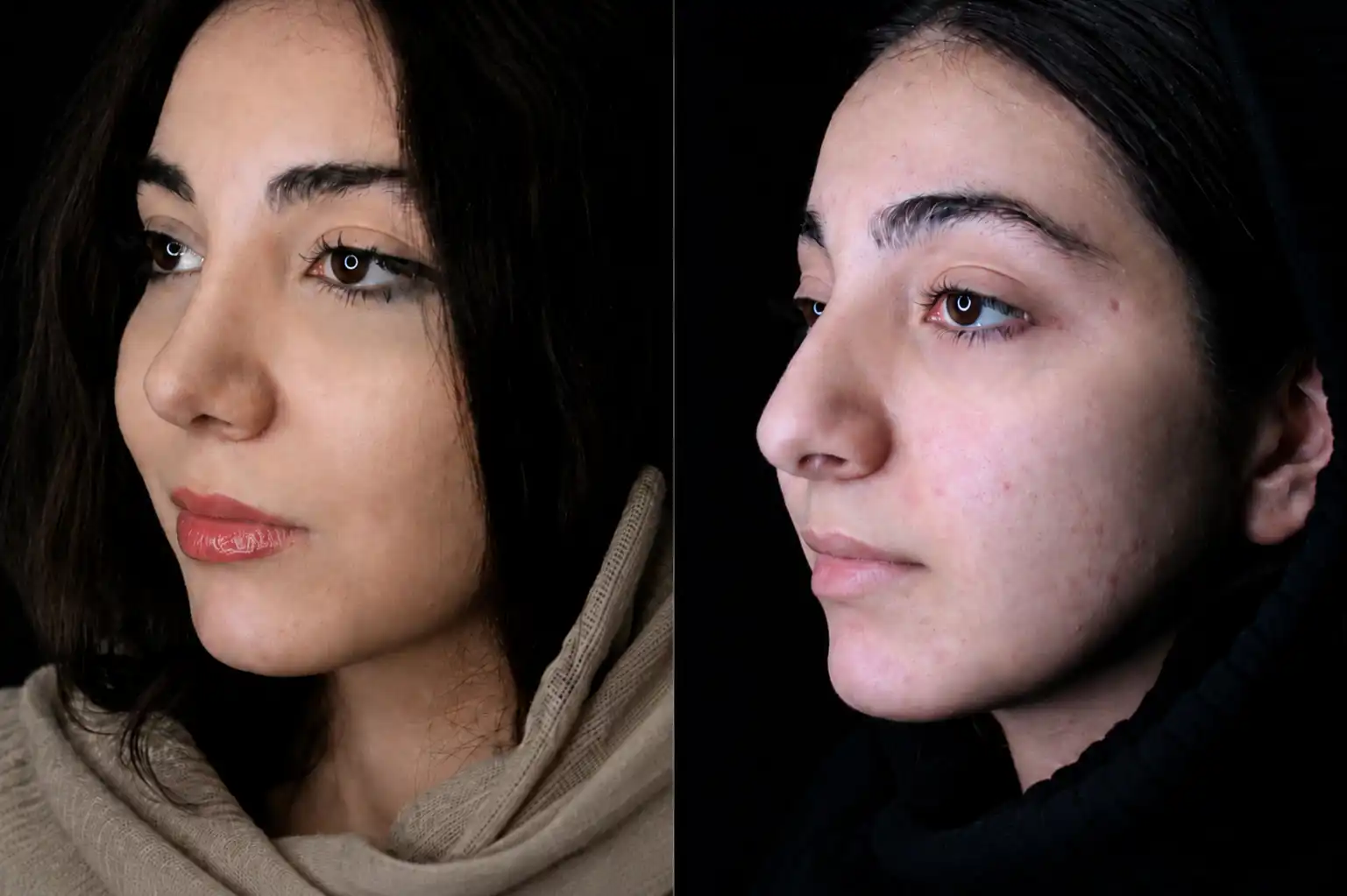 نمونه قبل و بعد عمل بینی شماره 36 - تصویر 1