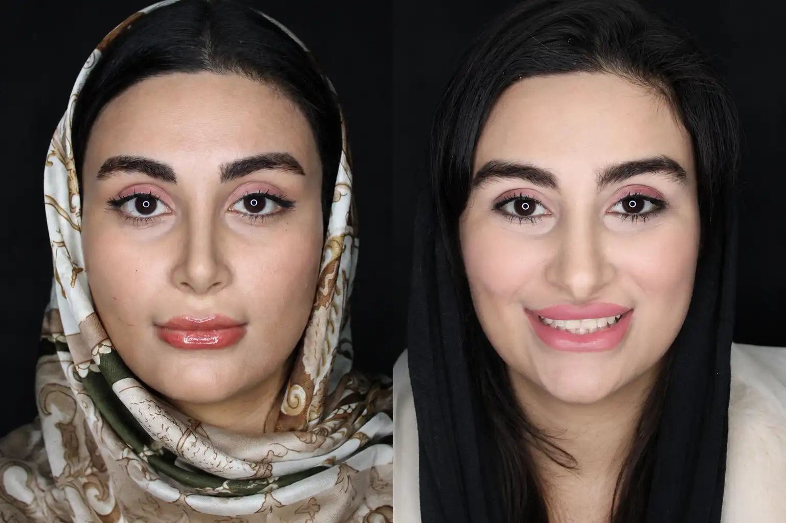 نمونه قبل و بعد عمل بینی شماره 38 - تصویر 2