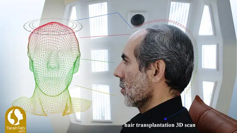 Hair transplantation by 3D scan method