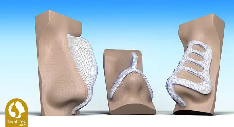 surgical guides