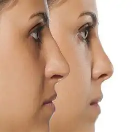 آزمایش های لازم قبل از جراحی بینی
