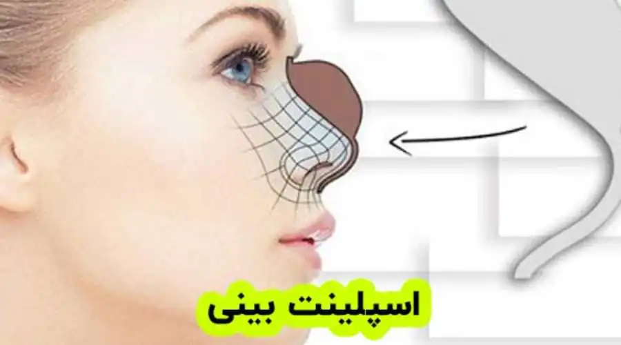 اسپلینت بینی چیست؟