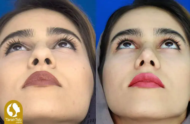 اصلاح سوراخ‌های بینی