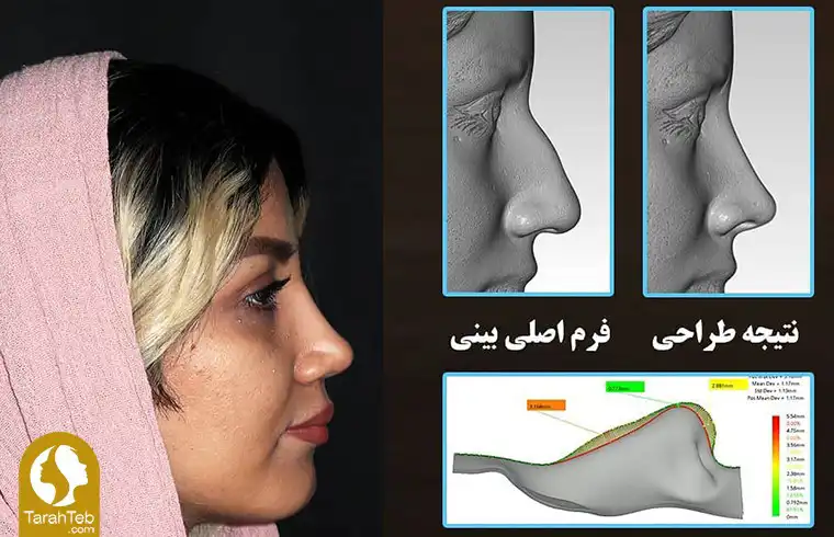 انتخاب جراح مناسب برای برداشتن قوز بینی