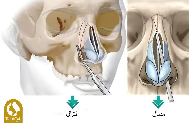 انواع استئوتومی در عمل بینی