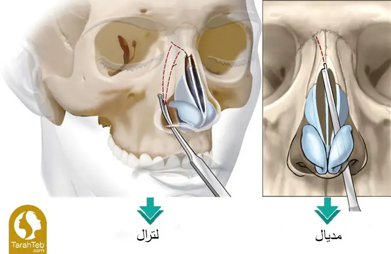 انواع استئوتومی در عمل بینی
