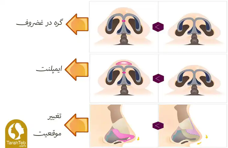 انواع تیپ پلاستی