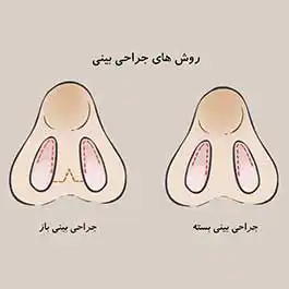 انواع روش جراحی بینی