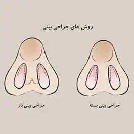 انواع روش جراحی بینی