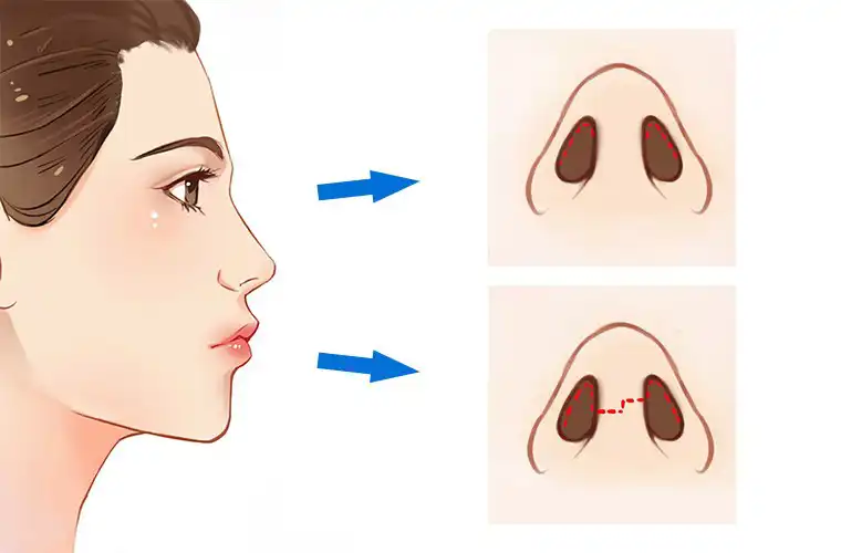 انواع روش جراحی بینی
