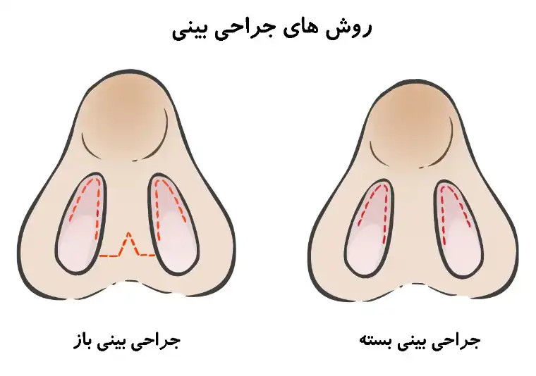 انواع روش های عمل بینی