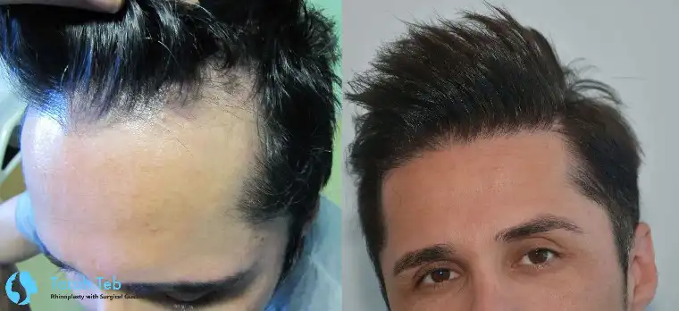 انواع روش کاشت مو