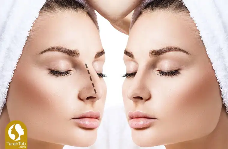 برداشتن قوز بینی