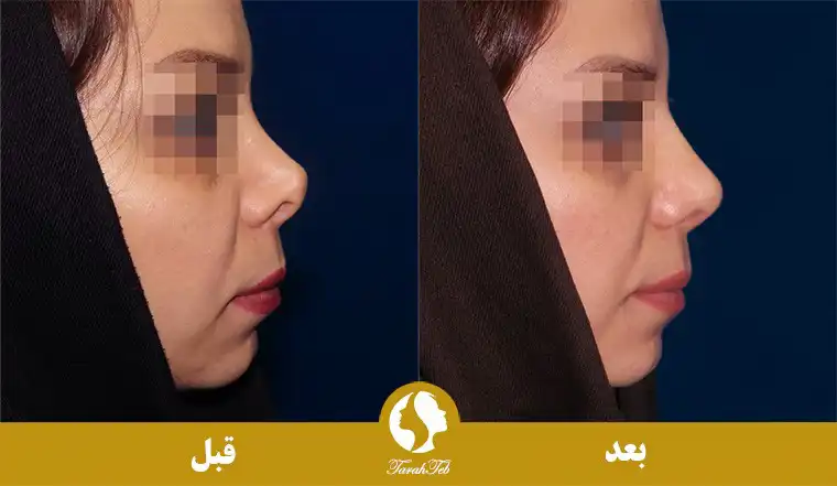 بزرگ کردن بینی