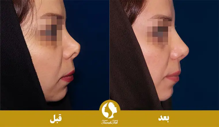 بزرگ کردن بینی
